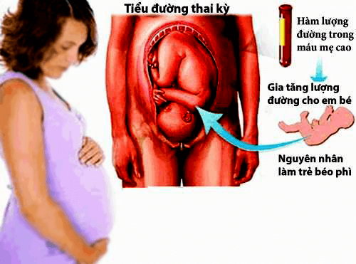 Đái tháo đường thai kỳ