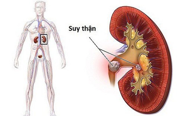 Biến chứng đái tháo đường trên thận