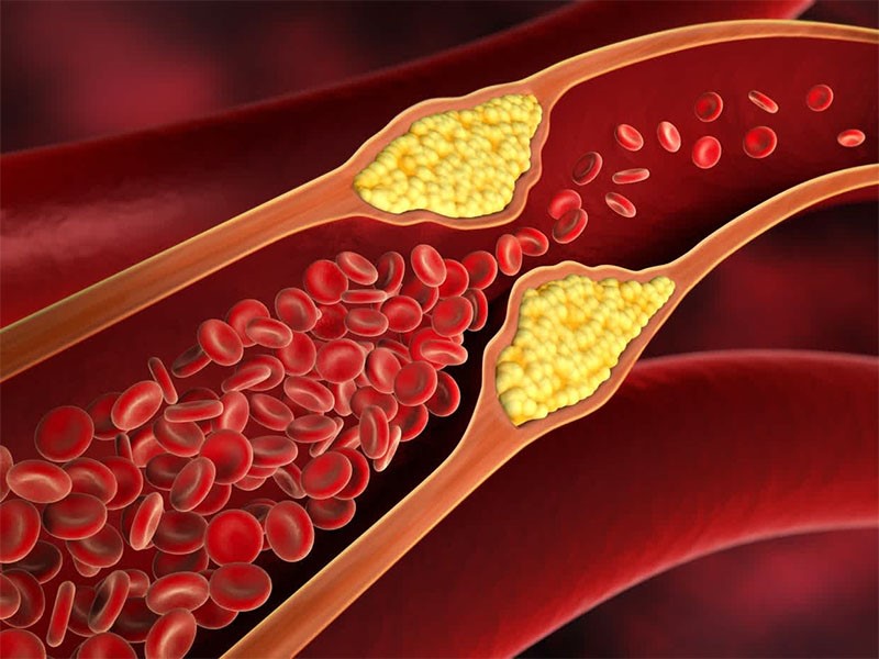 Hàm lượng cholesterol tăng cao dẫn tới nhiều biến chứng nguy hiểm