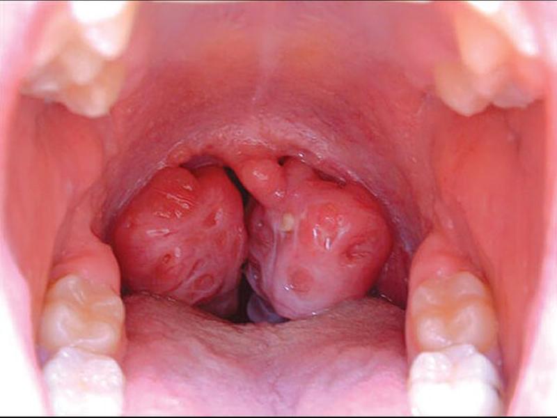 Căn bệnh ung thư vòm họng khá phổ biến tại Việt Nam