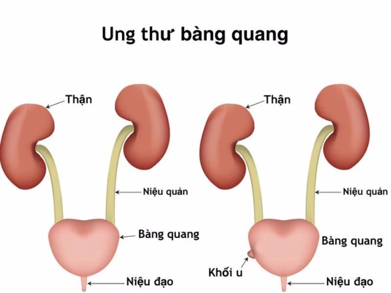 Hiện nay tỉ lệ mắc ung thư bàng quang ngày càng tăng cao