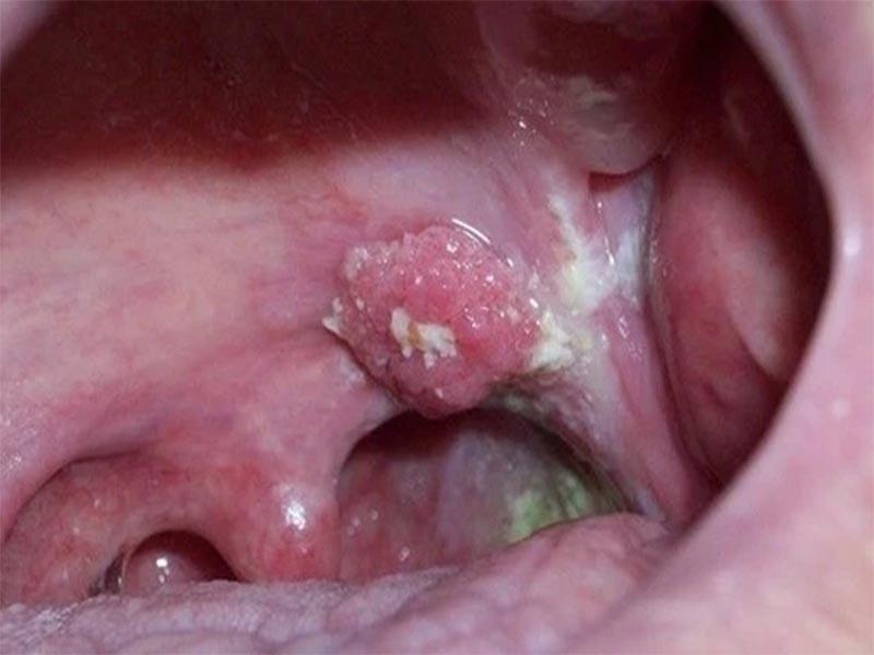 Kiểm tra các dấu hiệu bất thường tại vòm họng