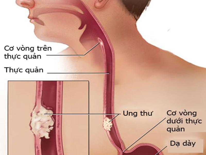 Căn bệnh ung thư thực quản đang có xu hướng gia tăng