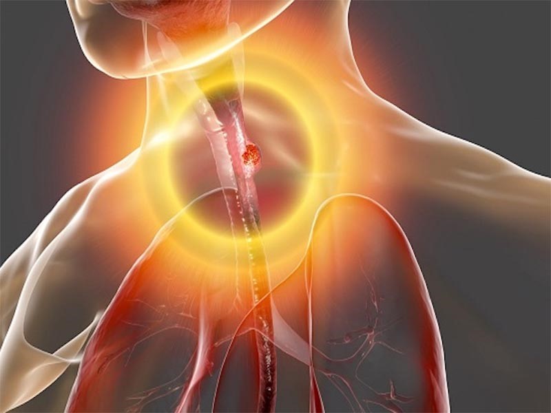 Nguyên nhân gây nên căn bệnh ung thư thực quản