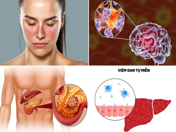 Bệnh tự miễn sống được bao lâu?