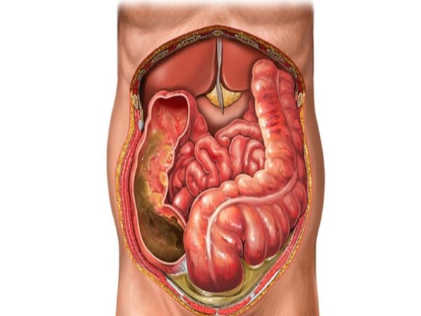 Đề kháng thành bụng cảnh báo sức khỏe không thể bỏ qua