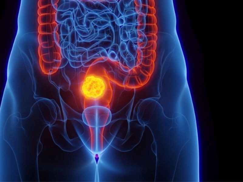 Cách chẩn đoán căn bệnh ung thư trực tràng giai đoạn 4