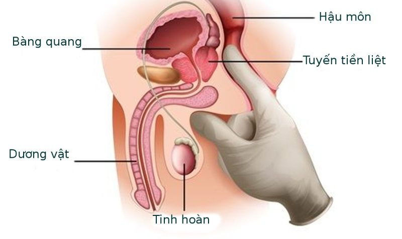 Căn bệnh ung thư tuyến tiền liệt