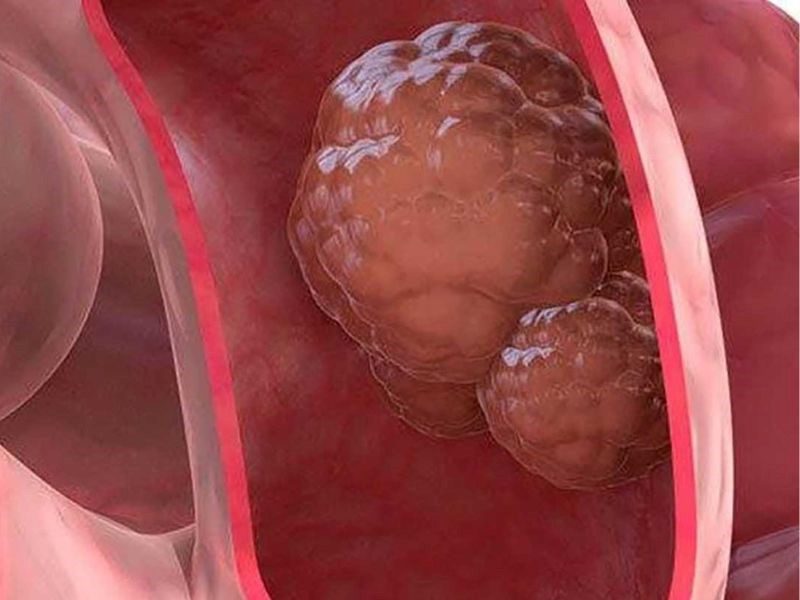 Phương pháp điều trị ung thư trực tràng giai đoạn 3