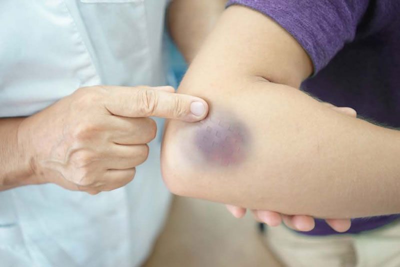 Dấu hiệu của bệnh ung thư máu