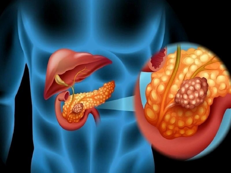 Các loại ung thư tuyến tụy