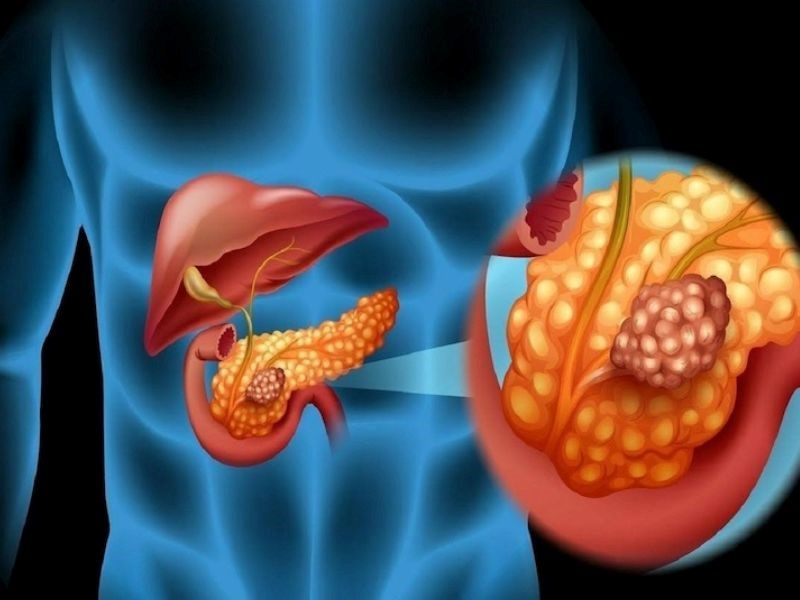 Căn bệnh ung thư tuyến tụy khá ít gặp nhưng rất nguy hiểm