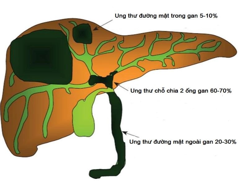 Nguyên nhân gây nên căn bệnh ung thư đường mật