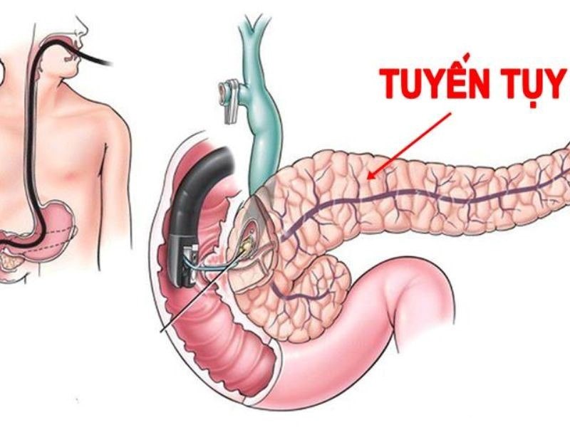 Ung thư tuyến tụy di căn gan thường ở giai đoạn cuối của bệnh