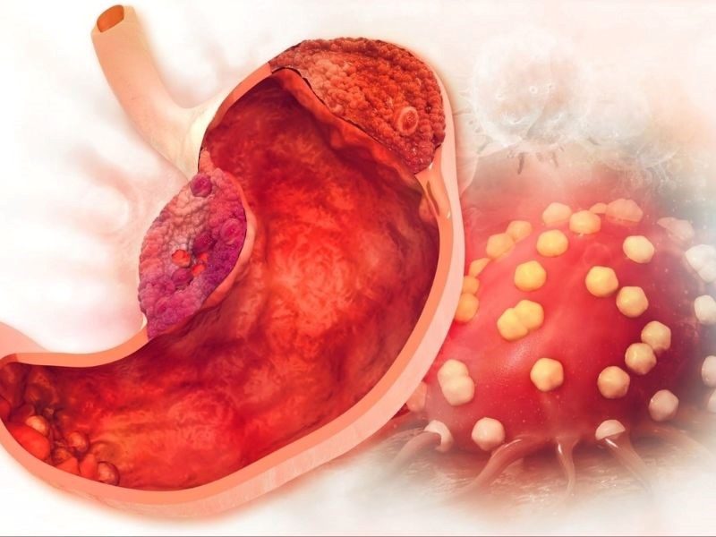 Biến chứng của căn bệnh ung thư dạ dày giai đoạn 3