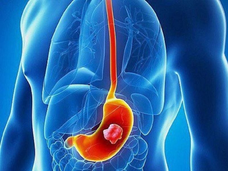 Căn bệnh ung thư dạ dày giai đoạn 3