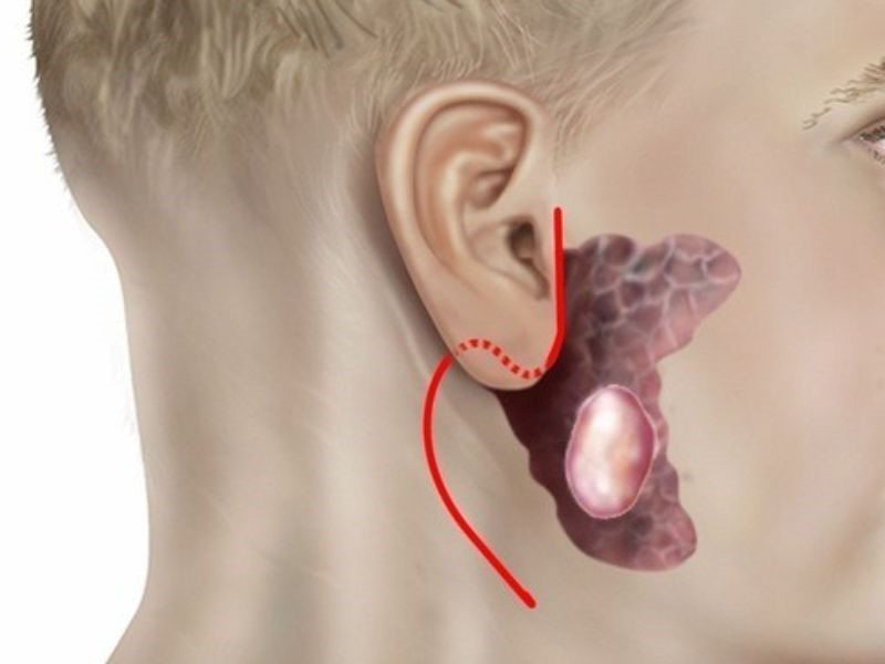 Đối tượng có nguy cơ mắc ung thư tuyến nước bọt