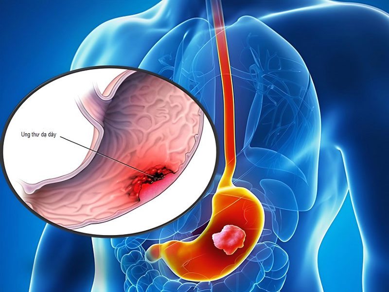 Nên điều trị dứt điểm các căn bệnh liên quan tới dạ dày