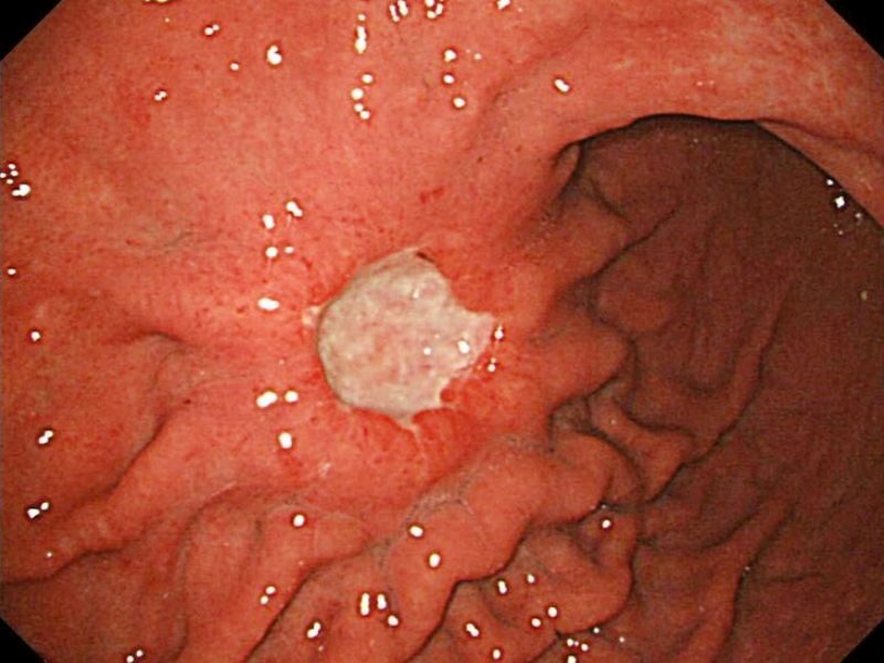 Phương pháp chẩn đoán ung thư dạ dày giai đoạn 3