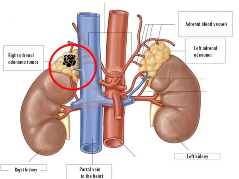 Triệu chứng của căn bệnh ung thư tuyến thượng thận