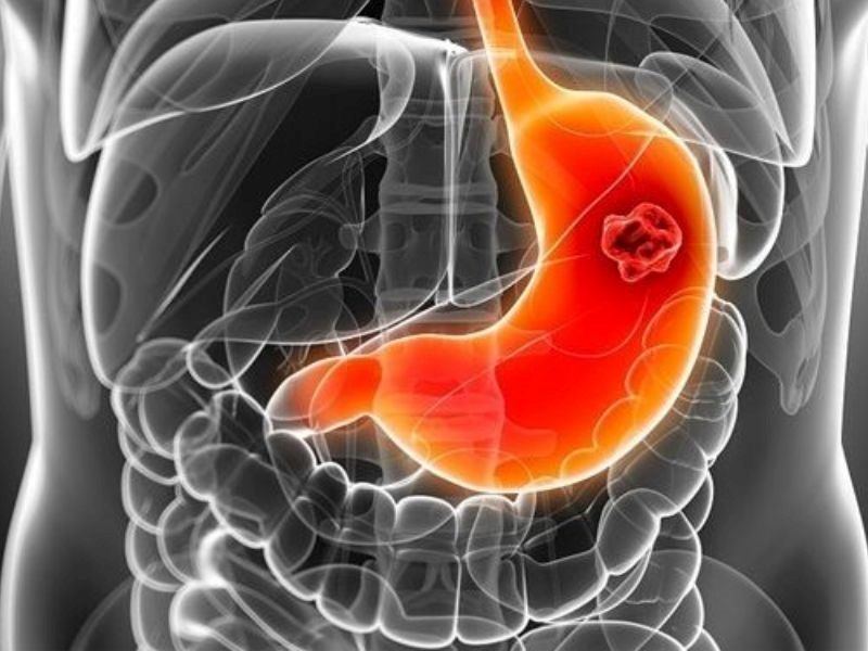 Ung thư dạ dày giai đoạn đầu có thể chữa được