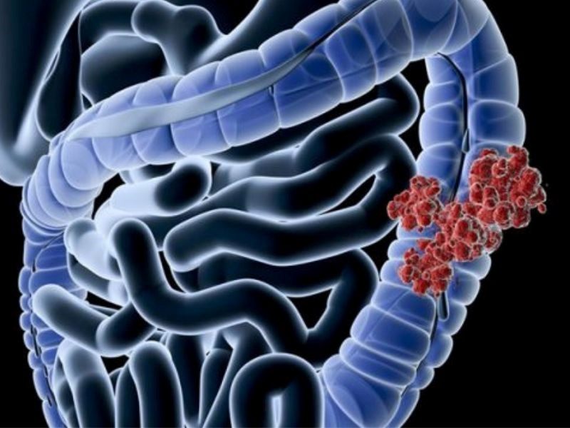 Ung thư dạ dày là căn bệnh ác tính và nguy hiểm