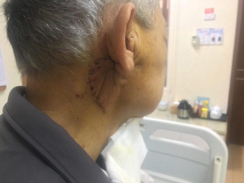 Ung thư tuyến nước bọt có lây không?