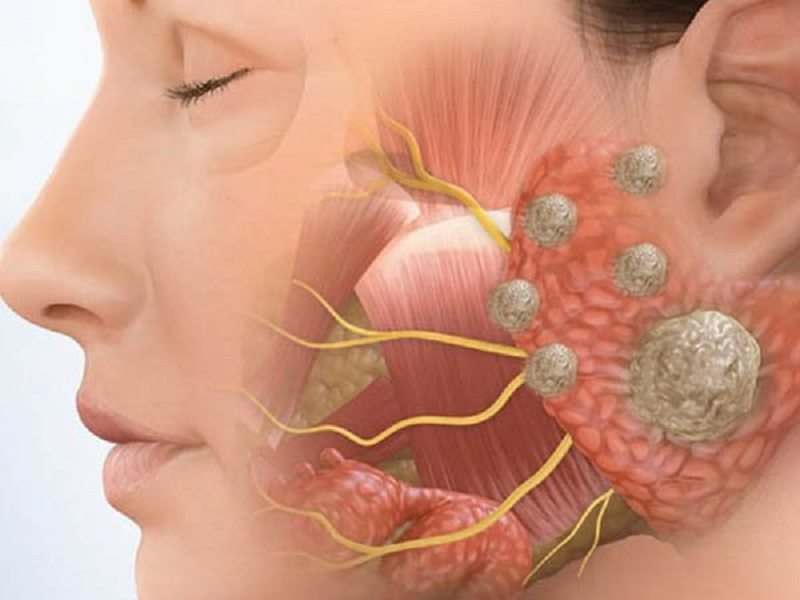 Ung thư tuyến nước bọt rất hiếm gặp