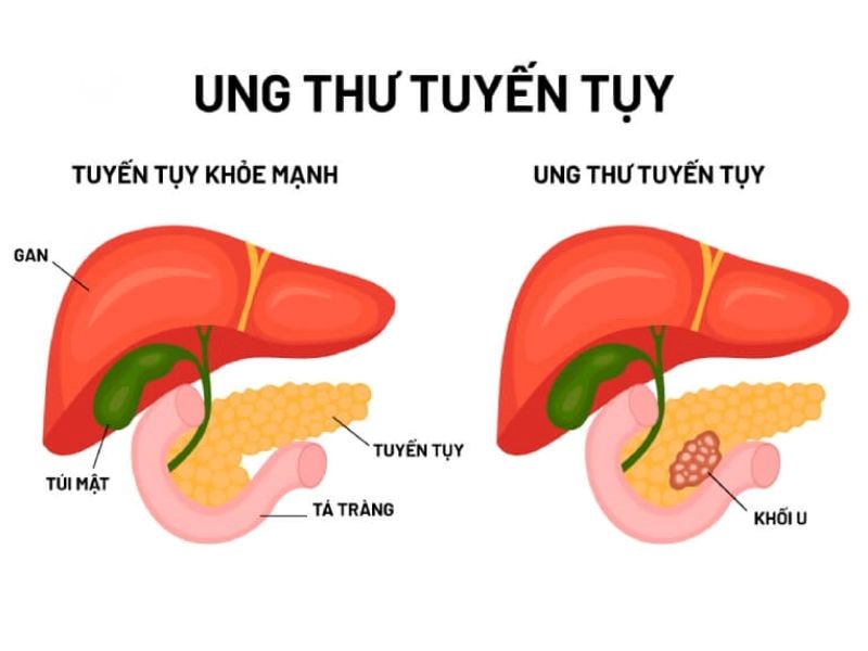 Các phương pháp điều trị ung thư tuyến tụy