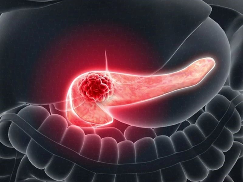 Nguyên nhân gây nên căn bệnh ung thư tuyến tụy