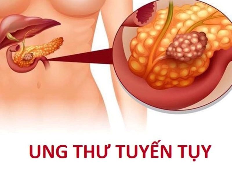 Ung thư tuyến tụy