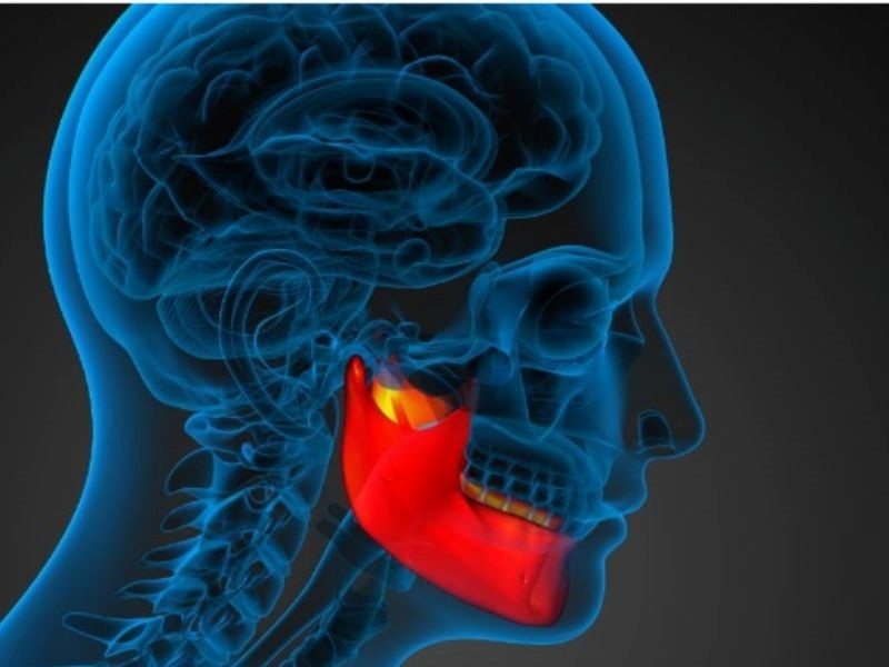 Ung thư xương hàm