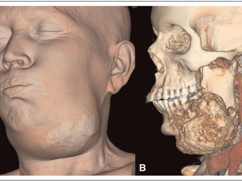 Ung thư xương hàm sống được bao lâu?