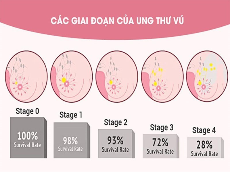 Các giai đoạn ung thư vú