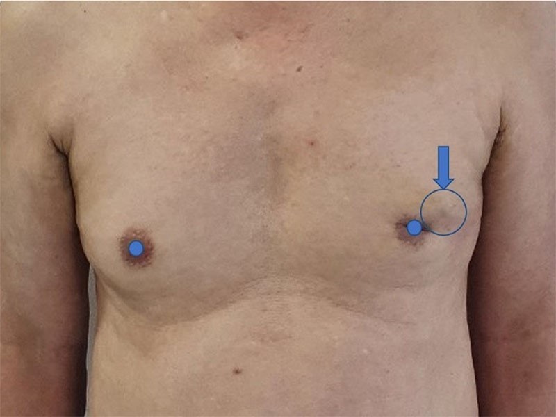 Các loại ung thư vú phổ biến hiện nay