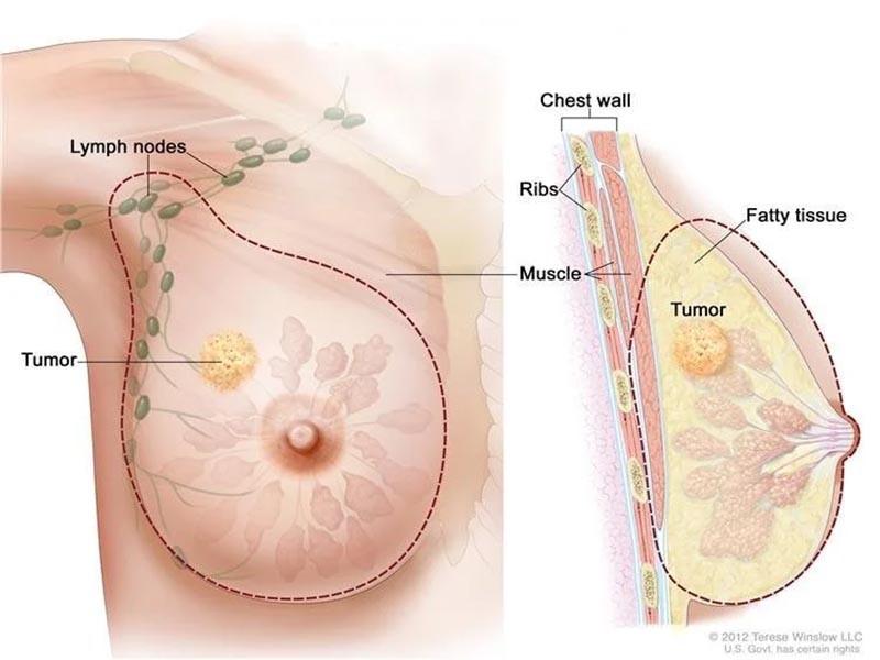 Các phân đoạn TNM của ung thư vú giai đoạn 1