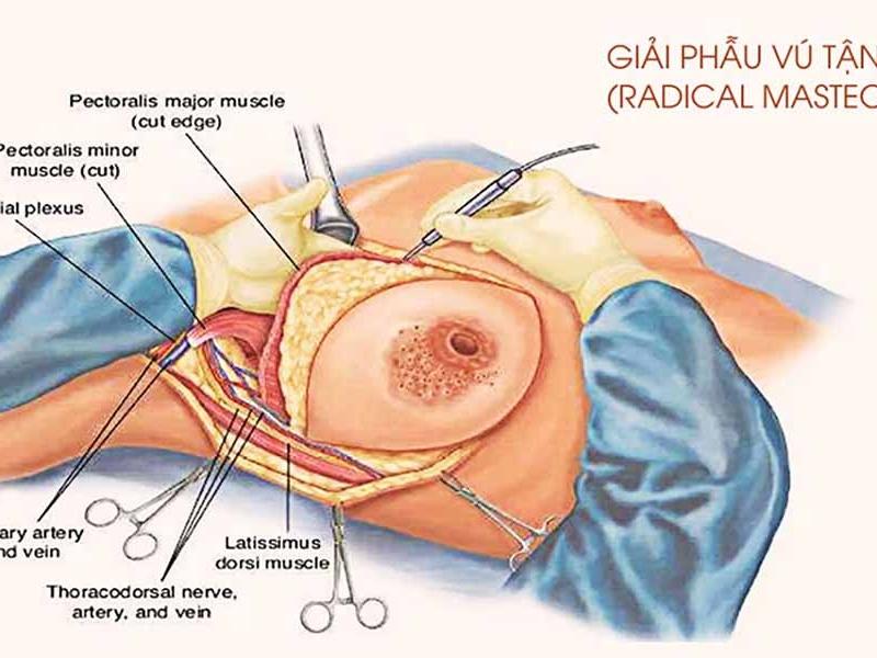 Phương pháp phẫu thuật tuyến vú