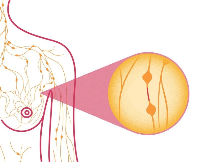 Sự khác nhau giữa ung thư vú dạng viêm và ung thư vú khác