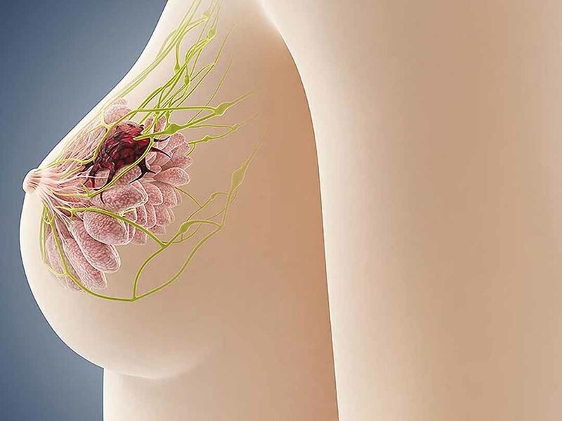 Tiên lượng sống của ung thư vú dạng viêm