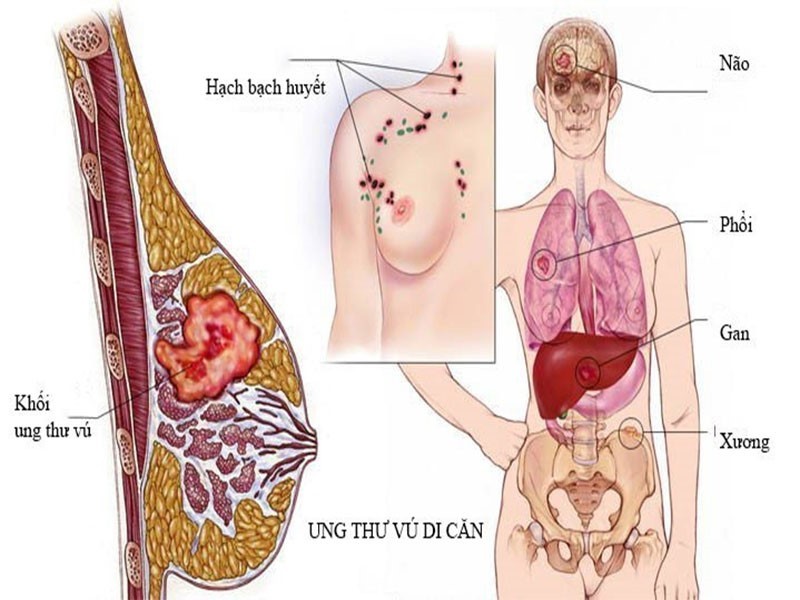 Tỷ lệ sống sót của bệnh nhân ung thư vú giai đoạn 4