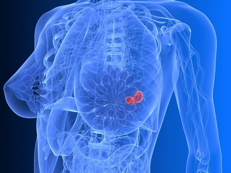 Ung thư vú xảy ra khi các tế bào ở vú phát triển không kiểm soát được
