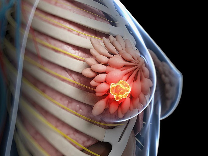Xuất hiện vết lõm đồng tiền