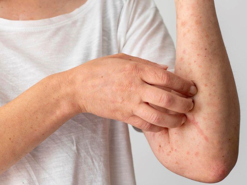 Ảnh hưởng của ung thư da tới sức khỏe