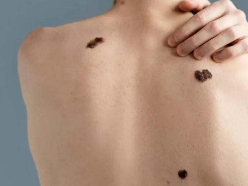 Bệnh ung thư da cần làm gì?