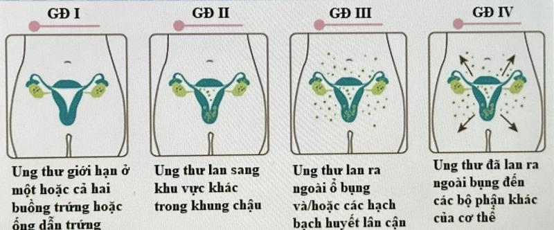 Các giai đoạn ung thư buồng trứng