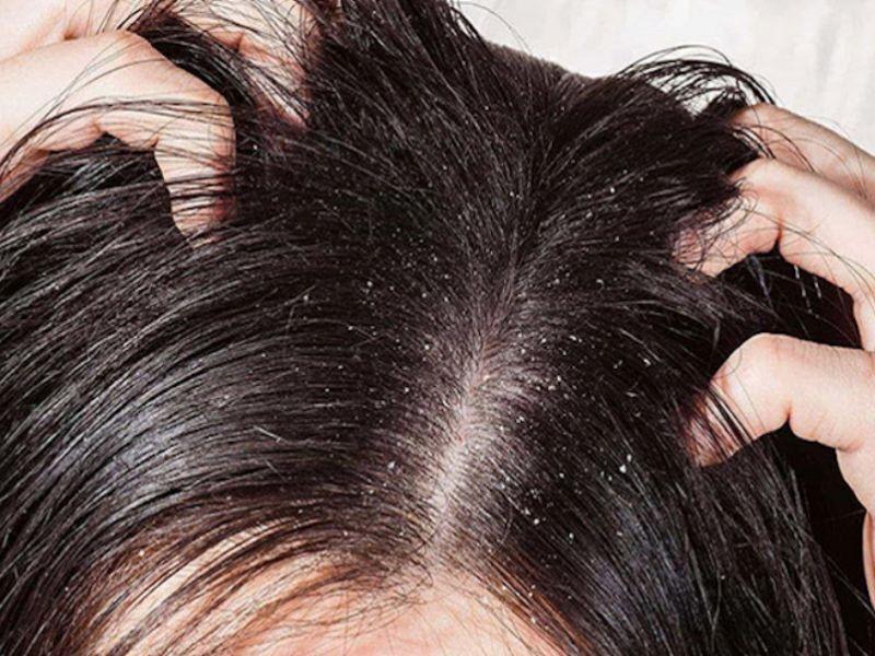 Các phòng ngừa căn bệnh ung thư da đầu