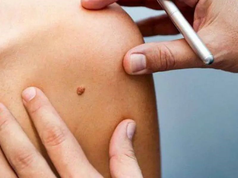 Các yếu tố ảnh hưởng tới tiên lượng sống của bệnh nhân ung thư da