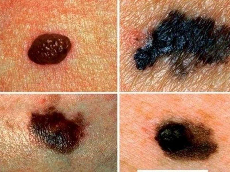 Căn bệnh ung thư hắc tố da có nguy cơ gây tử vong cao