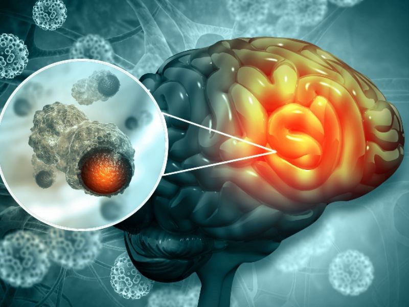 Căn bệnh ung thư não