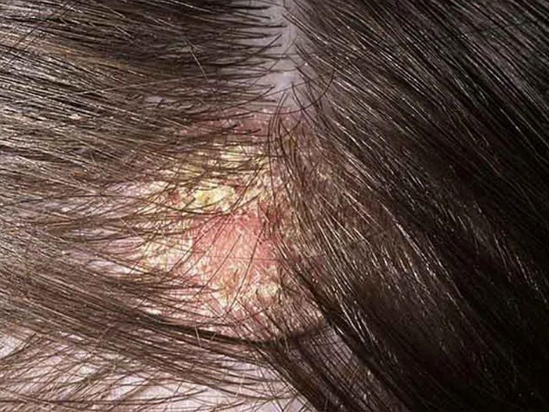 Dấu hiệu ung thư da đầu